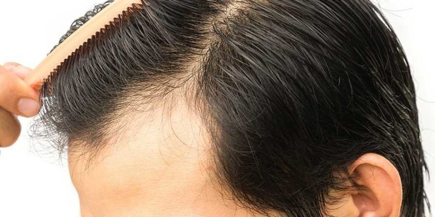 How Result of Hair Transplant could be Natural