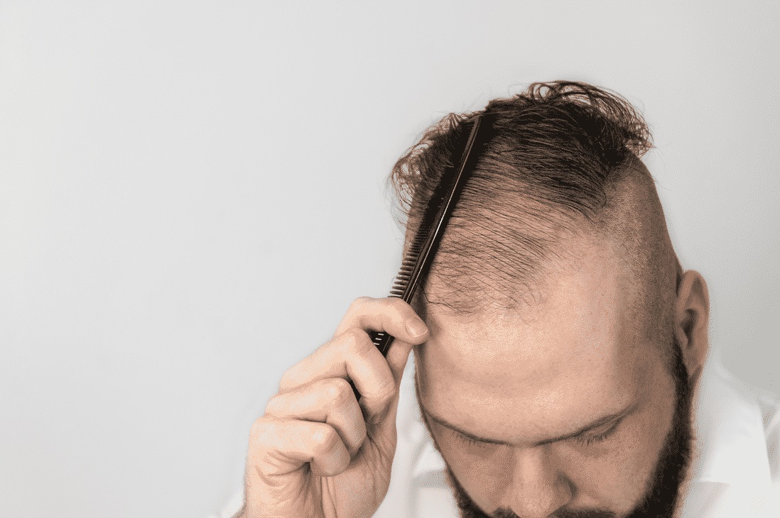 Top 5 Myths Prevalent in the Hair Transplant World