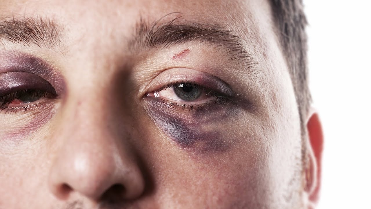 Visual Therapy And Black Eye